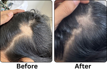 After Treatment