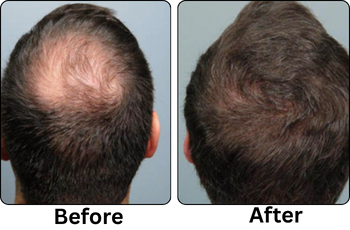 Before Treatment